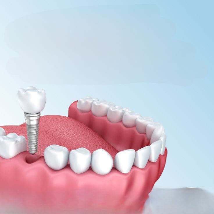 Dental Implants